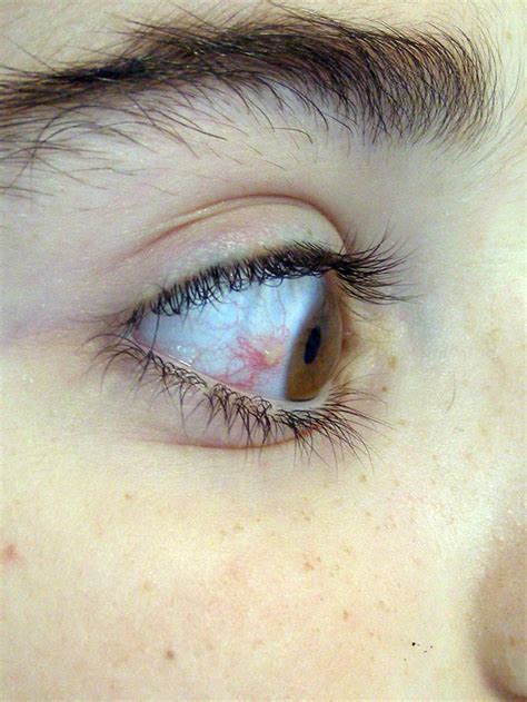 Continuum: Ojo rojo en Pediatría. ¿Todo son conjuntivitis?