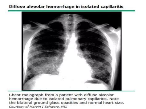 DIFFUSE ALVEOLAR HAEMORRHAGE | PPTX