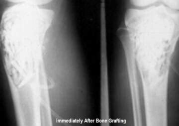 How Does A Bone Graft Work?