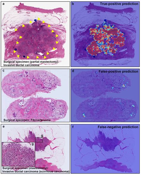 Breast Invasive Ductal Carcinoma Classification on Whole Slide Images ...