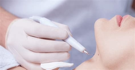 How Do Dermatologists Remove Skin Tags? (2023) - Skintify