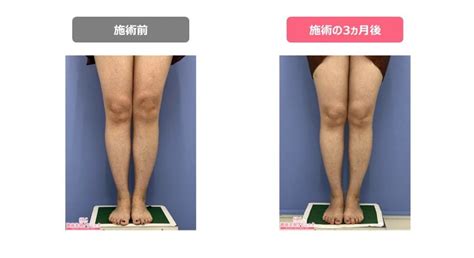 【症例あり】ふくらはぎの部分痩せをするには？きれいな脚を目指す方法をご紹介 | 医療ダイエット・医療痩身のお役立ちブログ