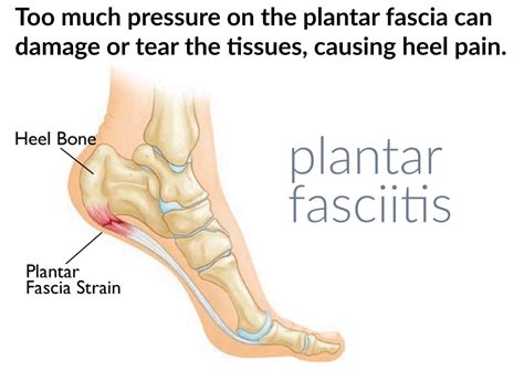 plantar fasciitis #1 foot problem - Professional Health Care Products