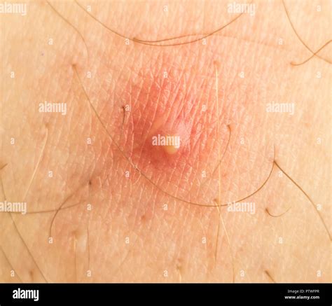 Rash Leg Stock Photos & Rash Leg Stock Images - Alamy
