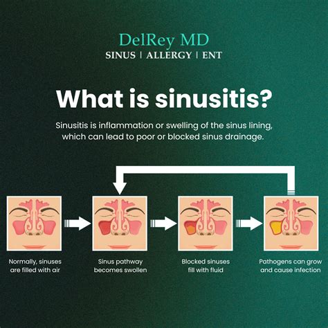 Sinusitis Treatment Marina Del Rey - Rhinosinusitis Long Beach