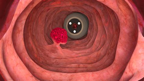 Image result for Polyp Detection Device