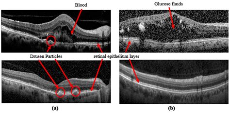 Distinctions between Choroidal Neovascularization and Age Macular ...
