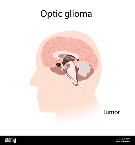 Optic Glioma