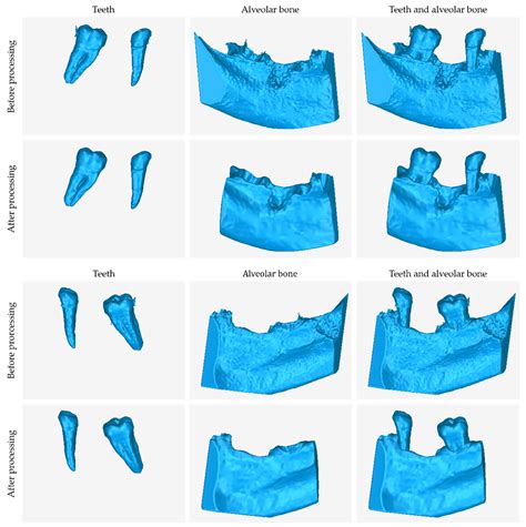 CBCT-Based Design of Patient-Specific 3D Bone Grafts for Periodontal ...