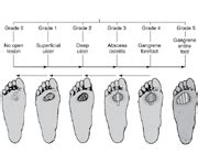 Wagner Ulcer Grade Classification Scale Flashcards | Quizlet