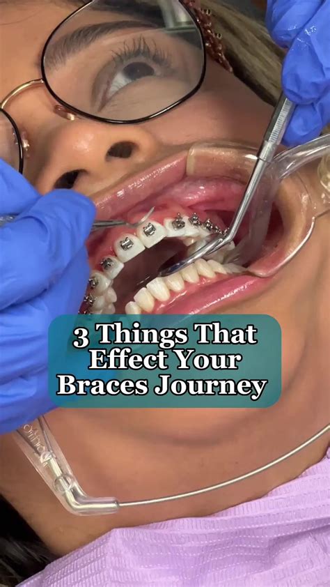 Eating with braces | Braces tips, Sensitive teeth, Cute braces