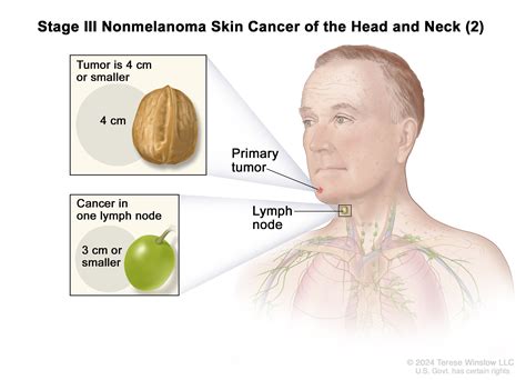 Lymph Nodes Neck Cancer