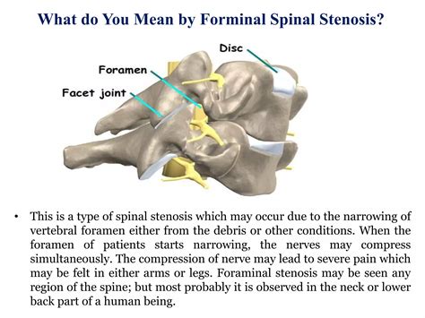 Treatment of foraminal stenosis | PPTX