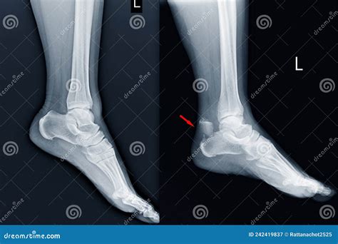 Calcaneus Bone X Ray