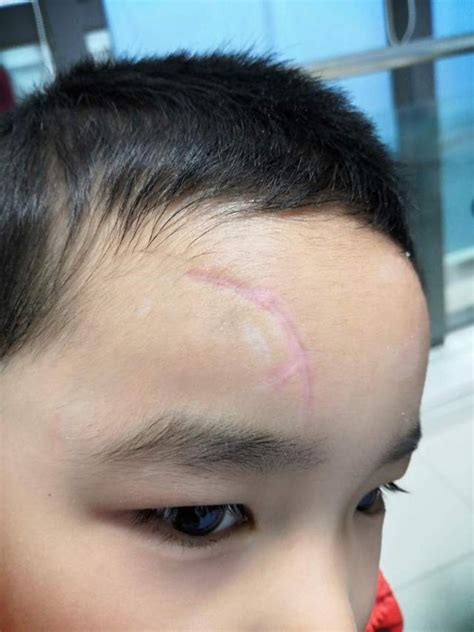 儿童外伤后怎么处理才能尽量减少瘢痕？ - 微医（挂号网）
