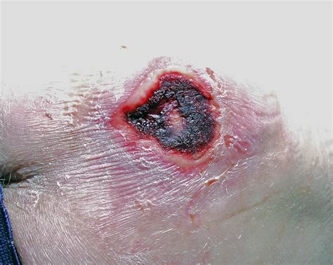 Notes on Practice: Elder Abuse or Kennedy Terminal Ulcer?