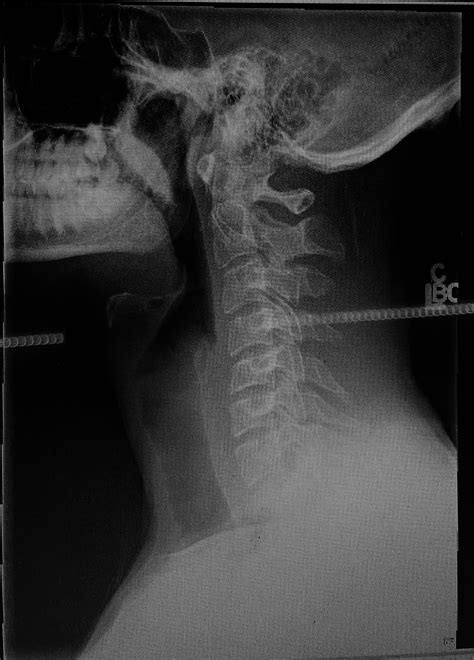 Cervical lordosis causing leg numb on neck extension? : r/SpineSurgery
