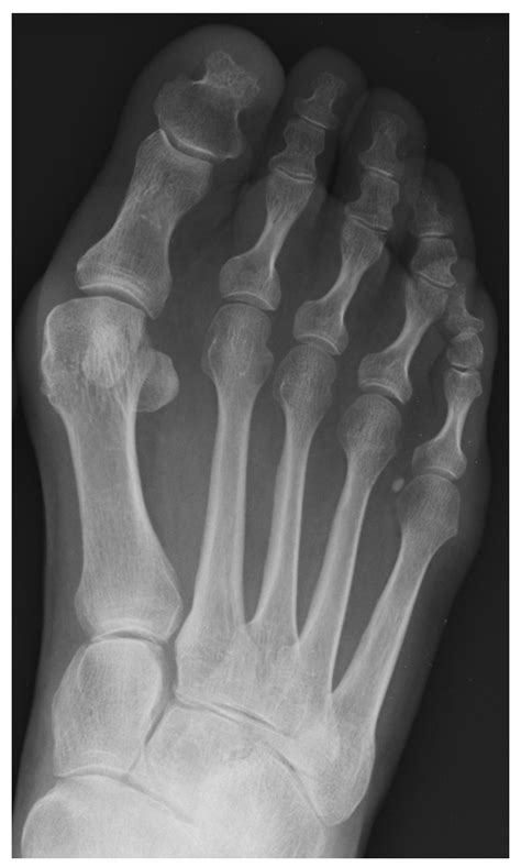 Scarf Osteotomy for Hallux Valgus Deformity. A Prospective Study with 8 ...