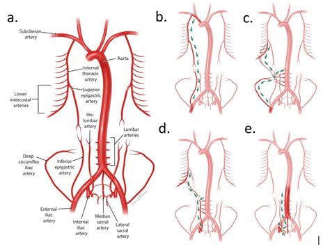 Occlusive Disease Coronary Artery Disease | Conditions & Treatments