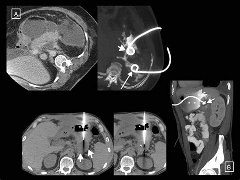 Radiology of acute pancreatitis today: The Atlanta classification and the current role of ...