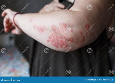 Psoriasis Skin. Psoriasis is an Autoimmune Disease that Affects the Skin Cause Skin Inflammation ...
