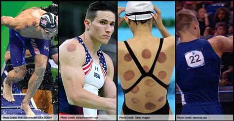 Image result for Cupping Tutorial