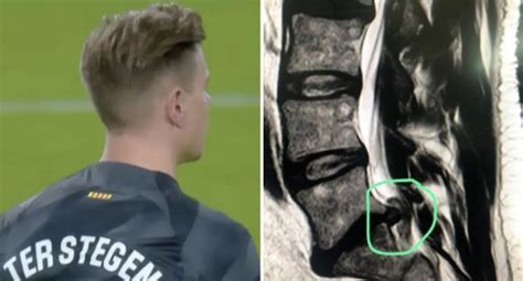 Confirmed: Ter Stegen to undergo back surgery, recovery time revealed - Football | Tribuna.com
