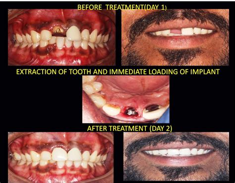 » Immediate Dental Implant after extraction