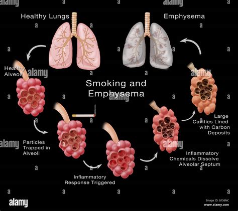 Stages of lung damage of a smoker leading to emphysema. The Stock Photo, Royalty Free Image ...