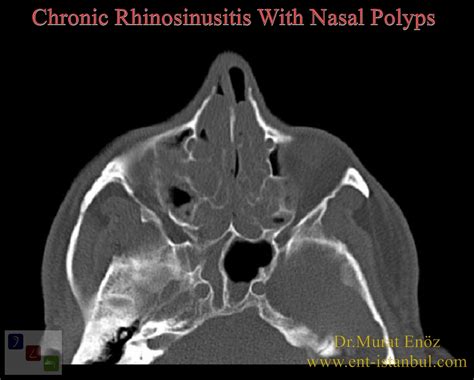 Nasal Polyp - Definition, Symptoms, Diagnosis and Treatment