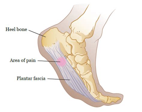 Plantar Fasciitis 的图像结果