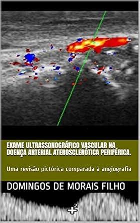 Exame ultrassonográfico vascular na doença arterial aterosclerótica ...