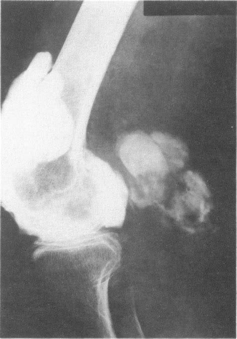 Image result for Back Arthrogram Technique