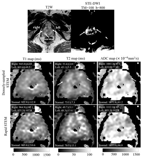 Diffusion MRI in the Body – Quantitative Imaging Methods Lab – UW–Madison