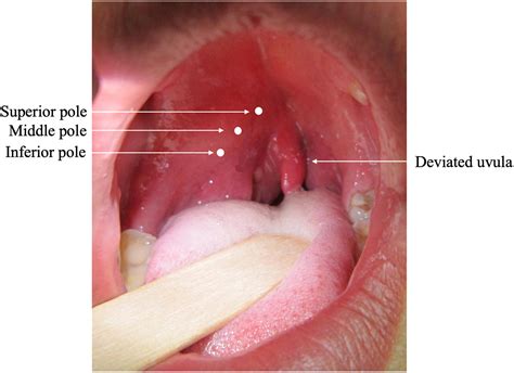 Managing Peritonsillar Abscess - Annals of Emergency Medicine
