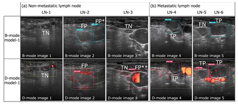 Metastatic Lymph Node Detection on Ultrasound Images Using YOLOv7 in ...