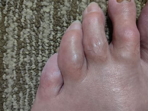 Blister on Bottom of Pinky Toe: Causes & Fixes
