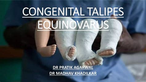 Talipes Equinovarus Ppt at Brad Schaffer blog