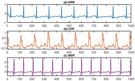 Deep-Learning-Based Arrhythmia Detection Using ECG Signals: A ...