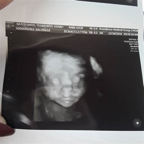 Anatomy Scan What To Expect