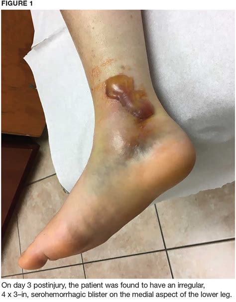 Woman, 57, With Painful, Swollen Ankle | Clinician Reviews