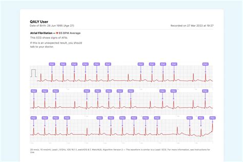 QALY | What Ectopic Atrial Rhythm Looks Like on Your Watch ECG