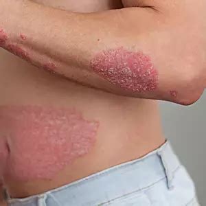 Treatment for Psoriasis in Mumbai With Latest Prices | Best Treatments ...