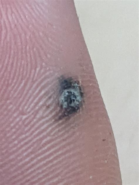 my wart turned black after a foot injury? what does that mean? it hurt for like 3 days after and ...