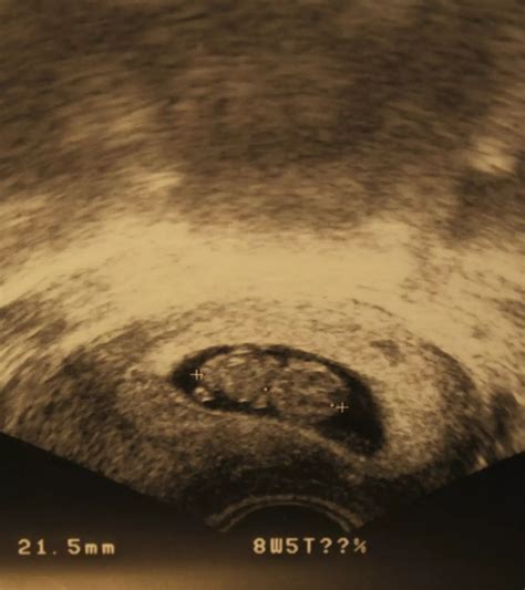 9 Weeks Pregnant: Complete Guide To Baby Development & Changes