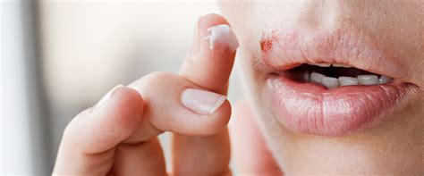 Cold sores: Symptoms, treatment & preventative measures | CURAPROX