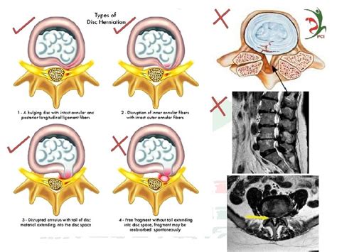 Image result for Disc FX Procedure