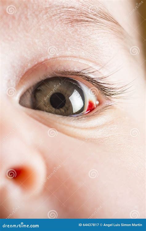 Red bloddshot eyes stock image. Image of glaucoma, allergy - 64437817