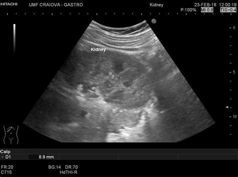 Kidney Stones Ultrasound Nephrolithiasis In Pregnancy: A Guide For