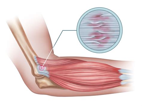 Tendinitis Trochanterica | Trochanterbursit, gluteus medius tendinit – PCYJ